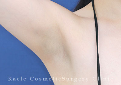 手術後12ヶ月目