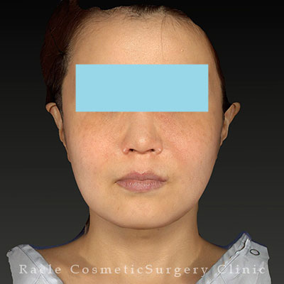 手術後12ヶ月目