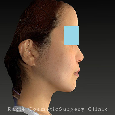 手術後12ヶ月目