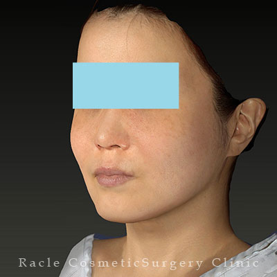 手術後12ヶ月目