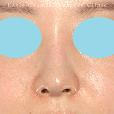 手術後12ヶ月目