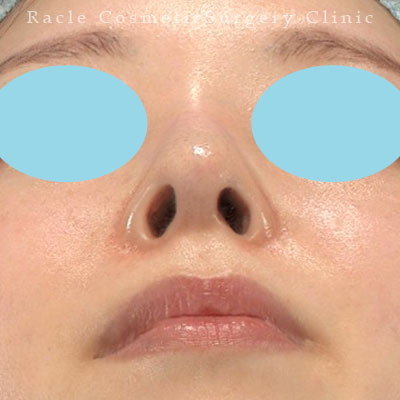 手術後12ヶ月目