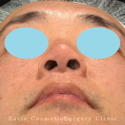 手術後12ヶ月目