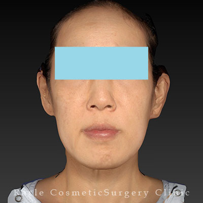 手術後12ヶ月目