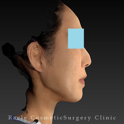 手術後12ヶ月目