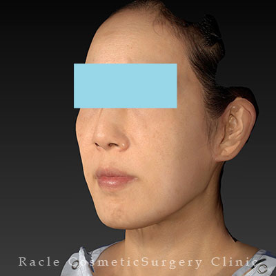 手術後12ヶ月目