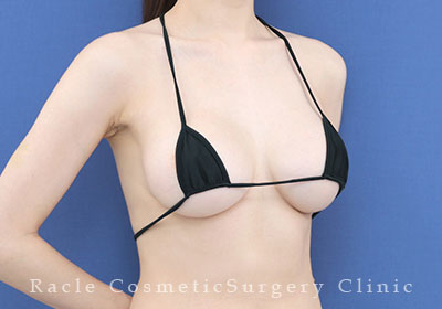 手術後12ヶ月目