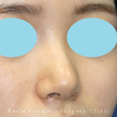 手術後12ヶ月目