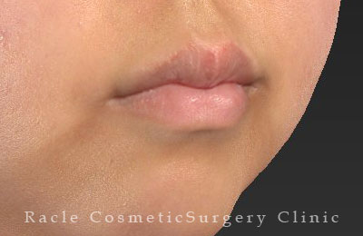 手術後12ヶ月目