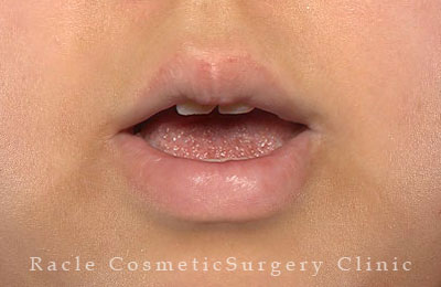 手術後12ヶ月目