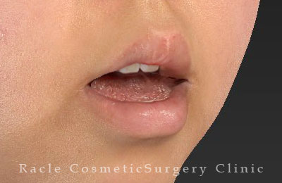 手術後12ヶ月目