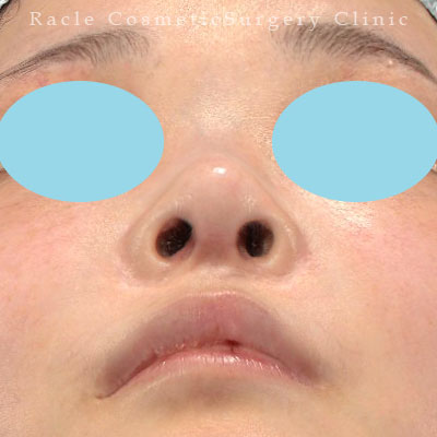 手術後12ヶ月目