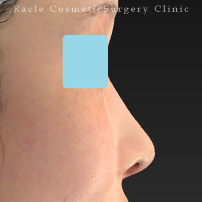 手術後12ヶ月目