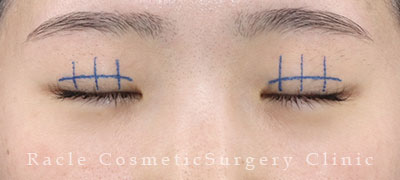 手術前デザイン