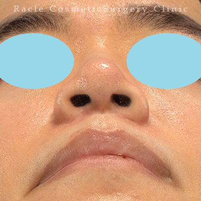 手術後12ヶ月目