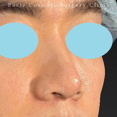 手術後12ヶ月目