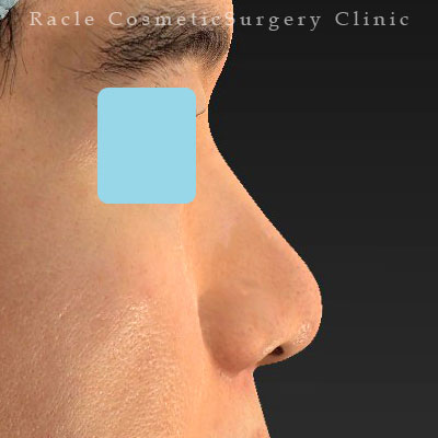 手術後12ヶ月目