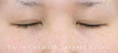 手術後12ヶ月目