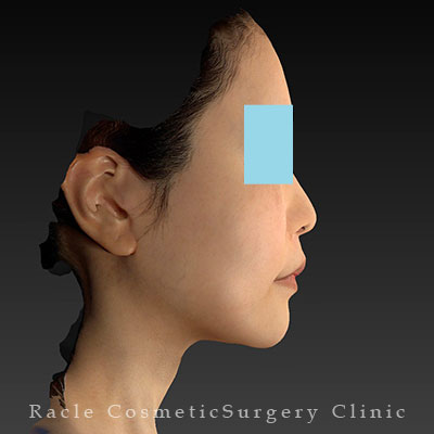 手術後12ヶ月目