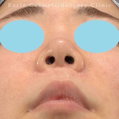 手術後12ヶ月目