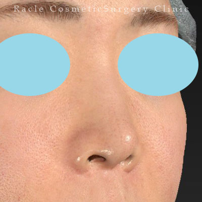 手術後12ヶ月目