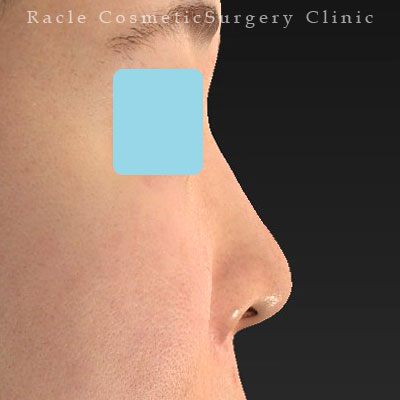 手術後12ヶ月目