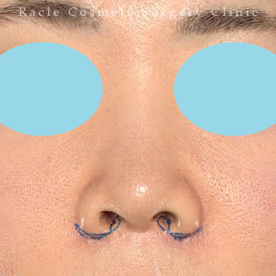 手術前デザイン