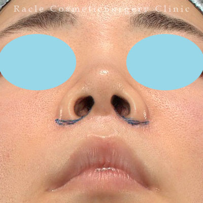 手術前デザイン