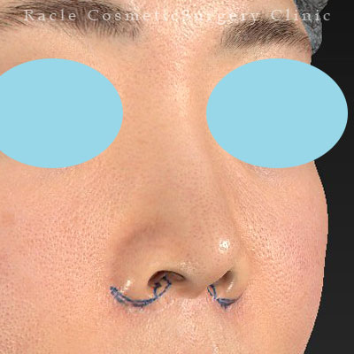 手術前デザイン