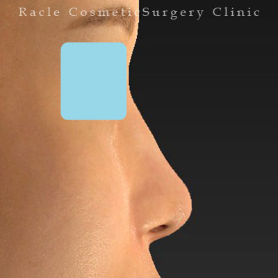 手術後12ヶ月目