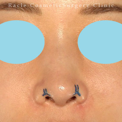 手術前デザイン