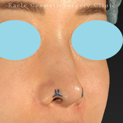 手術前デザイン