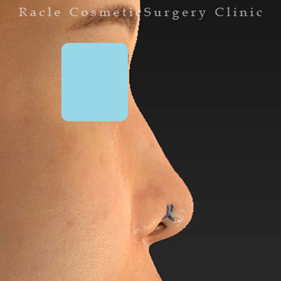 手術前デザイン