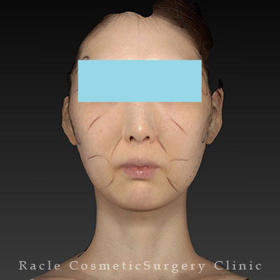 手術前デザイン