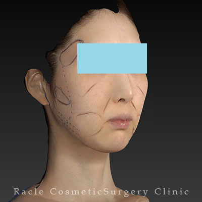 手術前デザイン