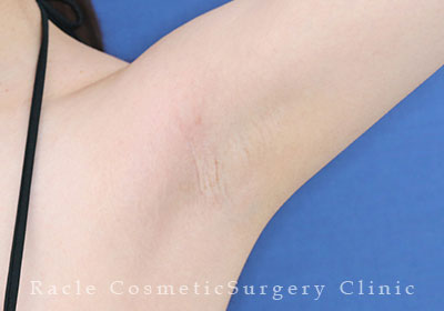 手術後12ヶ月目