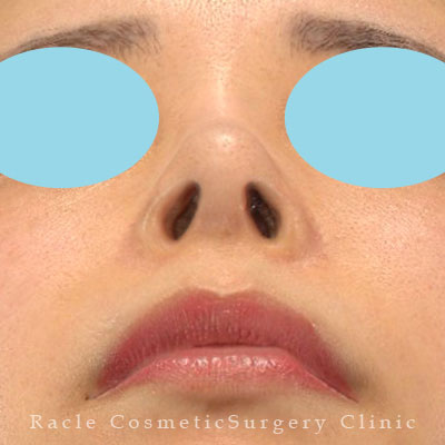 手術後12ヶ月目