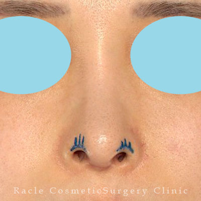 手術前デザイン