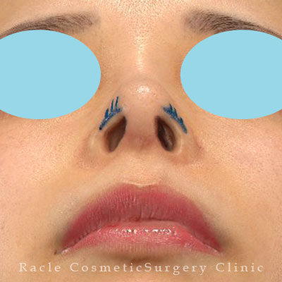 手術前デザイン