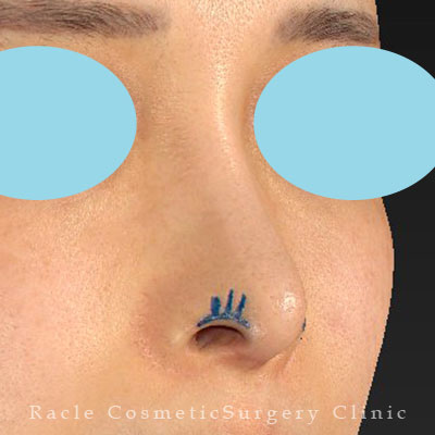 手術前デザイン