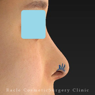 手術前デザイン