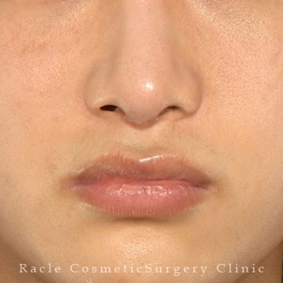 手術後12ヶ月目