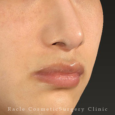 手術後12ヶ月目