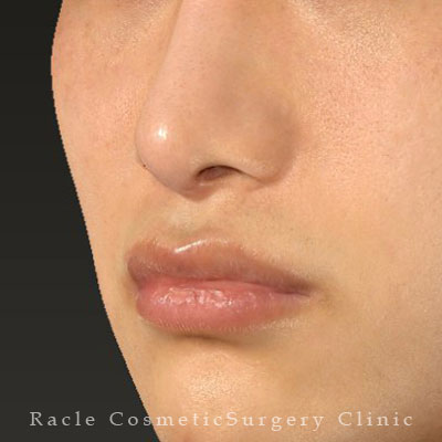 手術後12ヶ月目