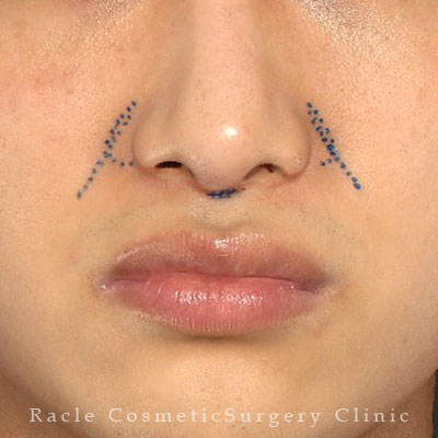 手術前デザイン