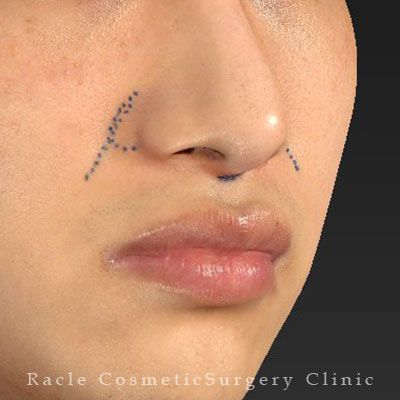 手術前デザイン