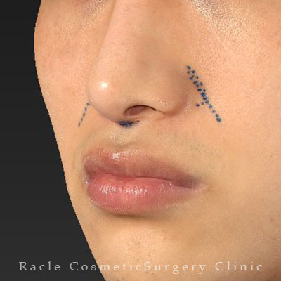 手術前デザイン