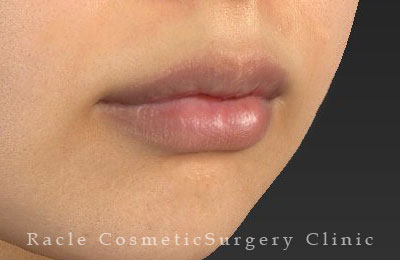 手術後12ヶ月目