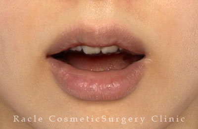 手術後12ヶ月目