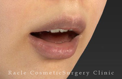 手術後12ヶ月目